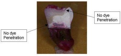 Class II dye penetration